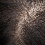 Hair Loss Treatment